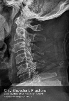 an x - ray image shows the back of a person's head and neck