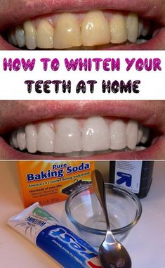 White Teeth Diy, Make Teeth Whiter, Whiten Your Teeth At Home, Teeth Whitening Homemade, Teeth Whitening Remedies, Teeth Whitening Diy, Diy Teething, Whiten Your Teeth