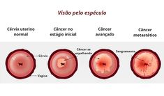 CÂNCER de COLO do ÚTERO! Sintomas que Jamais Devemos Ignorar! #cancerdecolo #cancerdecolodeutero #sintomasdecancerdecolodeutero #sintomadecancerdecolodeutero Romantic Drama