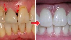 Swollen Gum, Dental Cavities, Loose Tooth, Periodontal Disease, Sensitive People