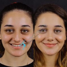 Rhinoplasty Surgery, Best Plastic Surgeons, Jobs For Women, Nose Job, Baby Skin Care, Hair Transplant