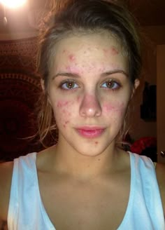 Get Rid Of Cystic Acne, Covering Acne, Cystic Pimple, Chest Acne, Get Rid Of Pimples, Rid Of Pimples, Forehead Acne, Pimples Under The Skin