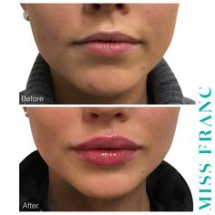 Lip Types, Facial Fillers, Facial Contouring, Lip Augmentation, Lip Filler, Botox Fillers