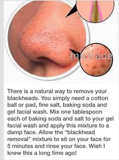 Black Heads, Remove Blackheads, Skin Care Solutions, Body Skin Care Routine, Diy Skin Care, Diy Skin, Healthy Skin Care, Beauty Skin Care Routine