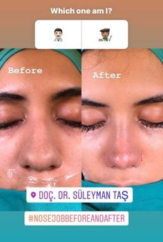 Rhinoplasty Bulbous Nose, Bulbous Nose Job Before And After, Thick Skin Bulbous Tip Rhinoplasty, Nose Job Thick Skin, Thick Skin Nose Job, Rhinoplasty Before And After Bulbous, Nose Job Before And After Bulbous, Thick Skin Rhinoplasty