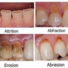 Dangerous Dental Care Logo #dentistrylife #DentalCareCavities Dental Implants San Diego | Dental hygenist, Dental hygiene school, Dentistry #Operative_Dentistry #Dental_Terminology #Dental_Hygienist_School #Dental_Assistant_Study Operative Dentistry, Dental Assisting, Dental World, Dental Assistant Gifts, Kedokteran Gigi