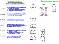 Definition G. V. Black Classification of Dental Caries. Greene Vardiman Black (1836–1915), commonly known as G.V. Black, is known as the father of modern dentistry in the US. #GVBlack #Dentistry #GVBlackClassificationofDentalCaries Dental Caries Classification, Operative Dentistry, Dental Infographics, Dental Nursing, Tooth Anatomy