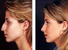 No reason to get a nose job... The original girl on the left is much more attractive and distinct. Kendall Jenner Plastic Surgery, Nose Surgery Rhinoplasty, Beauty Tips With Honey, Rhinoplasty Before And After, Best Plastic Surgeons