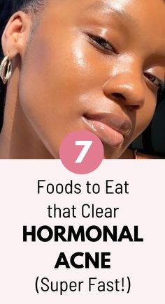 Hormonal acne has been a very serious struggle for me because I have a mixture of cystic acne and chin acne. I have learned that certain foods help get rid of jawline acne and chin acne. Treating cystic acne with these foods will actually help remove treat acne from the inside. Follow this hormonal acne diet by eating these foods. #hormonalacne #acnediet Hormonal Cystic Acne, Cystic Acne On Chin, Anti Acne Diet, Jawline Acne, Hormonal Acne Diet, Food For Acne, Treat Acne Naturally, Treating Cystic Acne, Chin Acne