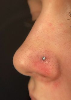 a woman's nose with acne on it and small white dot in the middle