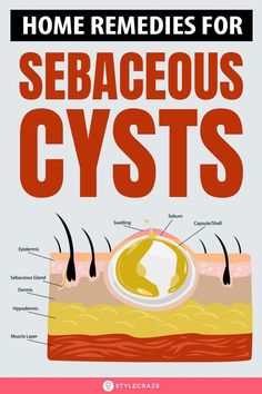 A sebaceous cyst is a small skin-colored growth that can form beneath the skin. Home remedies include flaxseed oil, apple cider vinegar, and crushed garlic. Cysts Remedies, Home Remedies For Cysts, Health And Fitness Magazine, Women Health, Updo Hairstyles, Fitness Advice, Knife Sheath, Neat Ideas, Lose 40 Pounds