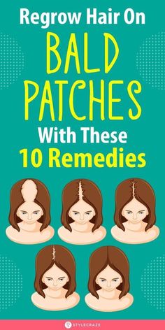 Bald Patches, Hair Growing Tips, Hair Remedies For Growth, Regrow Hair, Home Remedies For Hair, Hair Control, Hair Remedies