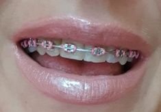 Baby Pink Braces, Light Pink Braces, Braces Pink, Perfect Teeth Braces, Oikawa Kinnie, Braces Ideas, Pink Braces, Cute Braces Colors, Teeth Aesthetic