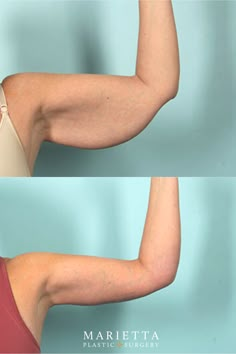 Before & After: Brachioplasty 💪 A Brachioplasty or arm lift is a procedure performed to remove excess skin and fat from the arms. An arm lift can help you obtain a more defined and toned appearance in the upper arm region. Arm Surgery Plastic Before After, Arm Surgery, Before And After Arm Workout, Before After Aesthetic, Arms Before And After Toned, Arm Lift Surgery Before And After, Arms Before And After, Arm Lipo Before And After, Skin Removal Surgery Before And After