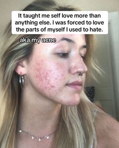 Thank you, acne 🤍. #adultacne #pcosacne #clearskin #glassskin #acnepositivity #acneneutrality August 15, Glass Skin, Clear Skin, Self Care, Self Love