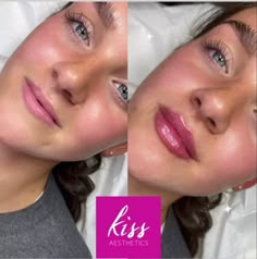 Lip Injection Techniques, Lip Filler Inspo 1 Ml, Small Lips Lip Filler, Lip Filler Inspiration 1ml, 1 Ml Lip Filler, 1ml Lip Filler Before And After, Lip Filler Before And After 1ml, Lip Injections Before And After, Lip Fillers Before And After 1ml