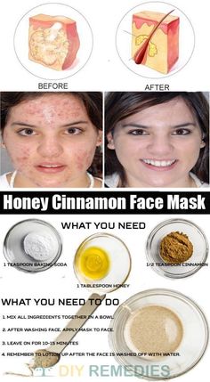 Honey Cinnamon Face Mask, Cinnamon Face Mask, Diy Cosmetics Recipes, Obličejové Masky, Honey Face Mask, Honey Cinnamon, Acne Face, Acne Face Mask, Diy Kosmetik