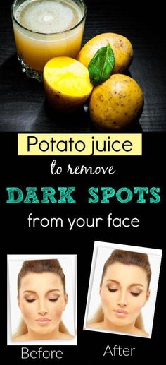 The Truth Behind Brown Spots on Face - Having brown spots on the face is not only disturbing, but it also may turn out to be a sign of more serious skin diseases and problems. You have to take note... Dark Circles Products, Tips For Dark Circles, Best Dark Spot Corrector, Dark Circles Under The Eyes, Potato Juice, Dry Skin Care Routine, Brown Spots Removal, Pure Aloe Vera