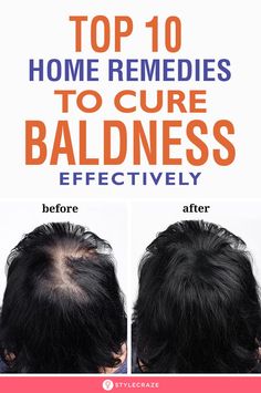 Bad Lifestyle, Top 10 Home Remedies, Hair Growth Secrets, Bald Patches, Hair Issues