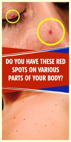 You’re the best! Glorious info! Skin Marks, Hair Diy, Organic Remedy, Skin Spots, Out Of Nowhere, Natural Health Tips, Health Guide, Health Awareness