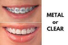 Clear Braces Vs Metal, Lingual Braces, Types Of Braces, Adult Braces