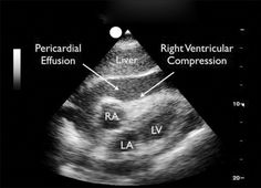 Pericardial Effusion, Mitral Valve, Critical Care