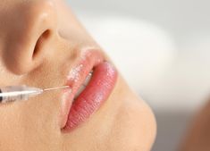 Lip Flip With Filler, Botox Benefits, Lip Line Filler, Botox Quotes, Filler Lip