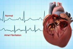 Visual Guide to AFib : Atrial Fibrillation http://www.webmd.com/heart-disease/atrial-fibrillation/ss/slideshow-af-overview?ecd=wgt_taboola_nosp_afib_ad13 Afib Atrial Fibrillation, Heart Symptoms, Coronary Arteries, Heart Surgery, Nursing