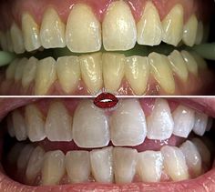 Professional Teeth Whitening | White teeth, Whitening, Teeth whitening #Dental_Health #White_Teeth_Tips #Whiter_Teeth #Hydrogen_Peroxide