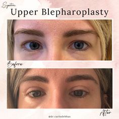 Eyelid Reduction (Blepharoplasty) Eyebag Removal, Improve Vision, Reduction Surgery, Extra Skin, Excess Skin, Surgery, Skin