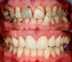 Teeth before and after treatment. Close up photo of teeth before and after treat #Sponsored , #AD, #Sponsored, #treatment, #treat, #teeth, #Teeth Bad Teeth Pictures, Teeth Before And After, Messed Up Teeth, Rotting Teeth, Teeth Painting, Teeth Decay, Dentistry Clinic, Teeth Pictures