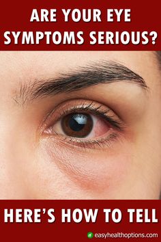 Eye Irritation Remedies, Red Eyes Remedy, What Causes Red Eyes, Redness Remedy, Itchy Eyelids, Swelling Remedies, Dry Eyelids, Swollen Eyes