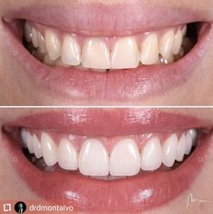 Perfect Smile Teeth, Porcelain Veneers, Dental Veneers, Dental Art, Smile Teeth