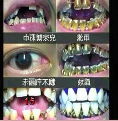 an image of teeth with different types of braces and gold foil on the upper part