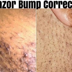 242 likes, 4 comments - naturalhairisdope on March 5, 2022: "@SkinSouffle has been proven to heal & smooth all skin tones. Their razor bump corrector & dark spot eraser combo have the solution for a...". Remove Razor Bumps, Razor Bumps Remedy, Razor Bump, Best Dark Spot Corrector, Black Owned Business, Acne Dark Spots, Natural Hair Regimen, Shaving Beard, Razor Bumps