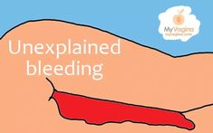 Explore the causes, symptoms, and treatments of Dysfunctional Uterine Bleeding (DUB), a common yet misunderstood condition. Too Much Estrogen, Protein Pudding, Estrogen Dominance, Signs And Symptoms, Bad Habits, Health Problems, Abs Workout, Conditioner, Health