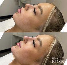 Natural Cheek Filler, Face Fillers Before And After Jaw, Nasal Labial Folds Before And After, Nose Botox Before And After, Facial Balancing Before And After, Nose Filler Before After, Face Fillers Before And After, Nose Job Inspiration Natural, Jawline Fillers Before And After