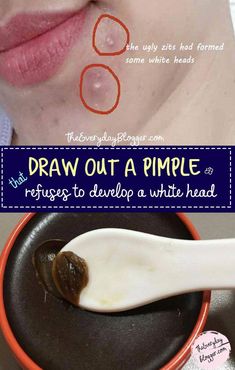 A blind pimple is an under the skin pimple with no head, this remedy will help to flush the area and draw the pimple to the surface of the skin & is ready to be drained without much effort. Ingrown Pimple, Hard Pimple, Deep Pimple, Zit Remedy, Painful Pimple, Drawing Salve, Cystic Pimple