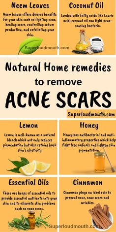 Natural home remedies to remove Acne scars Get Rid Of Acne, Rid Of Acne, Natural Acne, Home Remedies For Acne, How To Get Rid Of Pimples, Acne Remedies, Unwanted Hair Removal