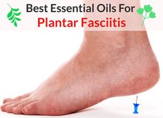 Essential Oils For Plantar Fasciitis: When Your Feet Start Protesting As Soon As You Take Your First Step of the Day! Essential Oils For Plantar Fascia, Walking Cast, Plantar Fascitis, Plantar Fascia, Pain Relief Remedies, Swollen Ankles, Essential Oils For Pain, Running Injuries, Foot Pain Relief