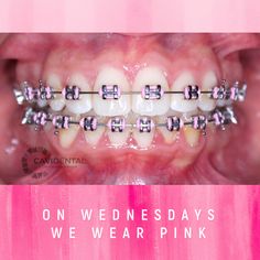 Dark Purple Braces Teeth, Pink Braces Aesthetic, Lilac Braces, Pink Dentist, Dream Teeth, Brace Ideas