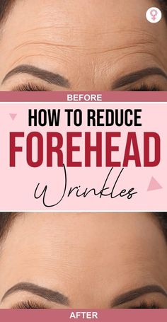 Learn effective ways to reduce forehead wrinkles with natural remedies, skincare routines, and lifestyle changes. These tips can help smooth fine lines, boost skin elasticity, and maintain a youthful appearance. Reduce Forehead Wrinkles, Gallbladder Removal, Unwanted Hair Removal, Prevent Wrinkles