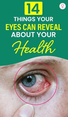 Eye Facts, Cold Sores Remedies, Natural Cold Remedies, Cold Home Remedies