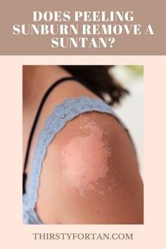 Let's talk about sunburns. Does peeling sunburn remove a suntan and why you should prevent your skin from getting to that peeling state? Peeling Skin From Sunburn How To Remove, How To Not Peel After Sunburn, How To Get Rid Of Peeling Skin Sunburn, Sunburn Peeling Remedies, Face Peeling From Sunburn, Skin Peeling From Sunburn, How To Remove Sunburn, Best For Sunburn