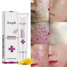 Effaclar Duo, Scar Removal Cream, Pimple Scars, Magnesium Benefits, Natural Acne Remedies, Acne Cream, How To Remove Pimples, Acne Spots, Acne Remedies