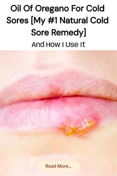 Save this pin to learn how I use oil of oregano for cold sores. If you’re looking for a natural cold sore remedy that packs a punch, this might become one of your favorites, too.