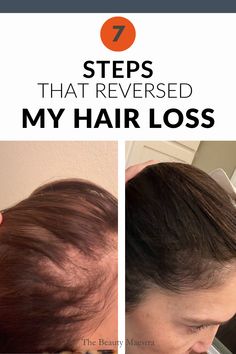 Reversing hair thinning is multi-faceted and unique to each individual. This post walks through the reasons why as well as what I did to successfully regrow my hair. Thinning Hair Remedies, Stop Hair Breakage, Scrub Corpo, Regrow Hair, Hair Control, Lost Hair, Hair Thickening, Hair Product, Hair Remedies