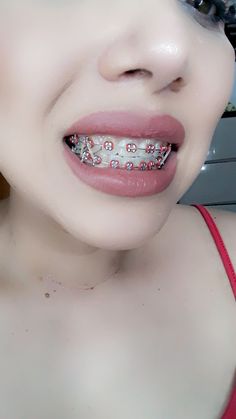 Brackets Aesthetic, Brace Colors, Dental Braces Colors, Red Braces, Silver Braces, Braces Rubber Bands, Pretty Teeth