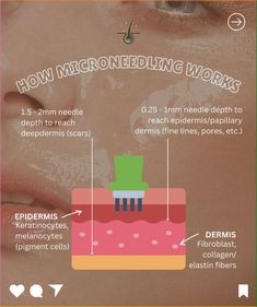 Curious about Facial Microneedling? 🌟

This amazing treatment uses tiny needles to stimulate collagen, reduce fine lines, and enhance skin texture!✨

Whether you’re battling wrinkles or just want that radiant glow, microneedling is your secret weapon. Microneedling Before And After, Skincare Pictures, Microneedling At Home, Skin Aesthetics, Advanced Skin Care, Facial Rejuvenation, Acne Scar Removal, Skin Care Clinic, Facial Spa