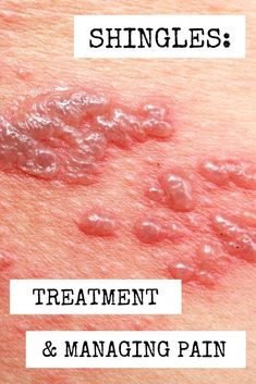 Healthcare professionals can help relieve patient pain and discomfort caused by shingles with these in-hospital or home care treatment options. Shingles Pain Relief, Shingles Remedies, Essential Oils For Shingles, Treating Shingles, Shingles Relief, Nerve Pain Remedies, Knee Pain Relief Remedies, Pain Relief Remedies